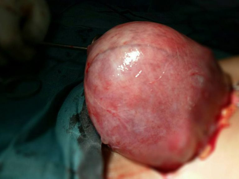 saiz fibroid