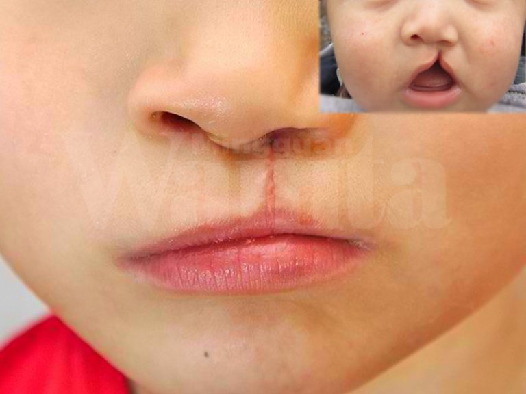 bayi sumbing