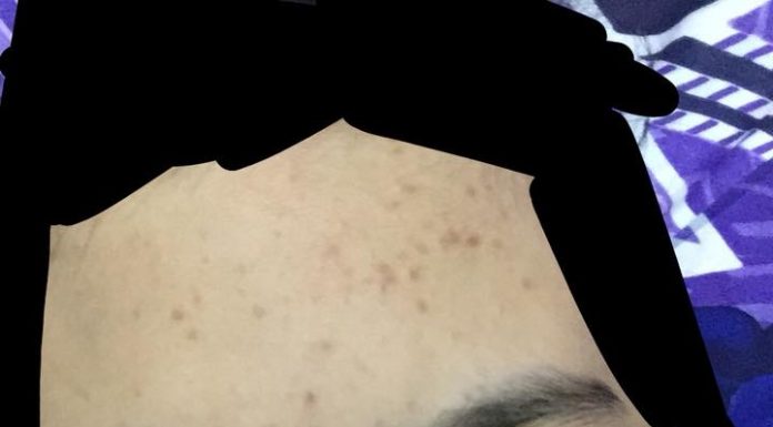 8 Bulan Wanita Ini Cuci Muka Guna Tomato Beku, Kesannya  