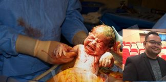 caesarean