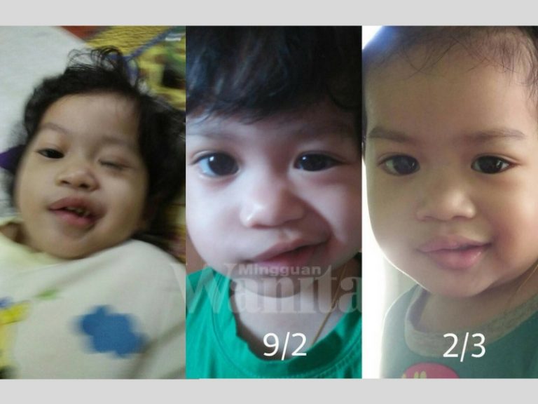 Tak Sangka Korek Telinga Selepas Baru Pulih Demam Boleh Kena ‘Bell Palsy’, Jadi Punca Muka Senget Sebelah