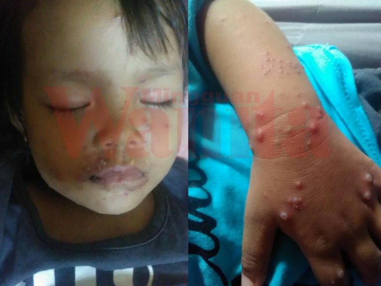 chicken pox