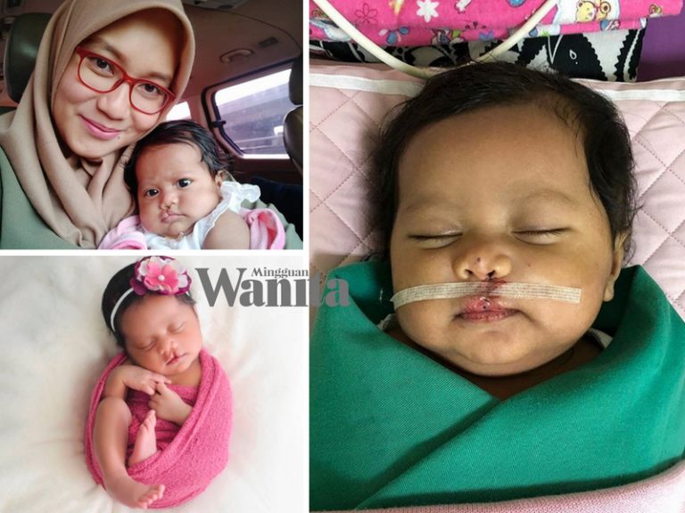 Alhamdulillah Pembedahan Sumbing Baby Xandra Dah Selesai, Ini Doa Lan Solo Untuk Anaknya