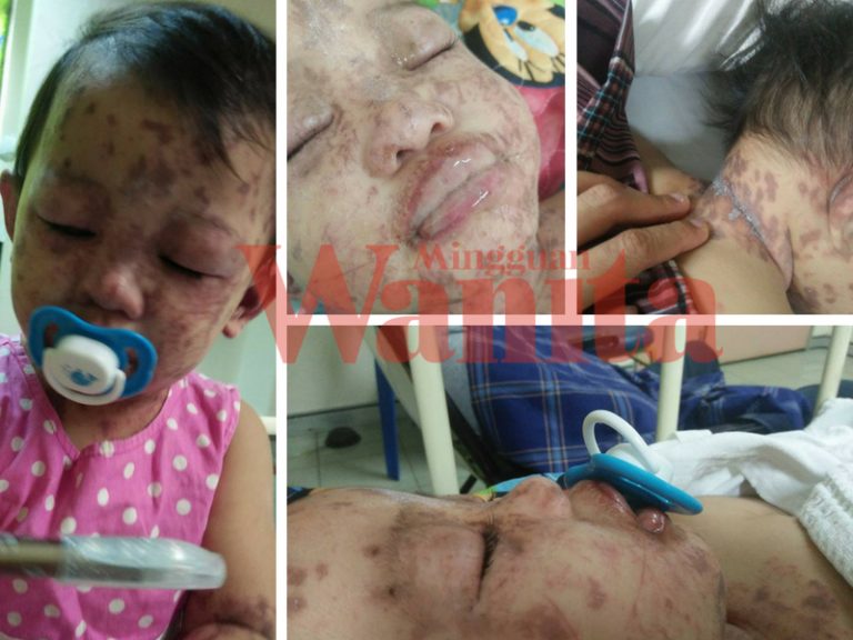 “Bibir, Sekitar Mulut, Mata, Dan Leher Keluar Nanah. Tolong Doakan Aisya Kembali Sihat…” Ibu Mangsa