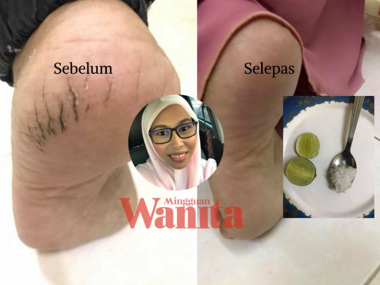 tumit kaki