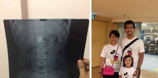 Dah Masuk Hari Ke-8 Syiling Dalam Perut Haqeef Masih Belum Keluar..