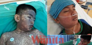 Sindrom Steven Johnson (SJS)