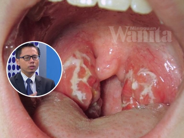 buang tonsil