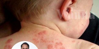 Resah Anak Ekzema, Hati-hati Sapu Kulit Merengsa Itu Dengan Macam-macam Petua