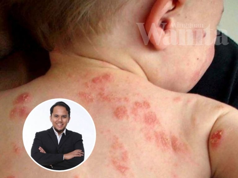 Resah Anak Ekzema, Hati-hati Sapu Kulit Merengsa Itu Dengan Macam-macam Petua