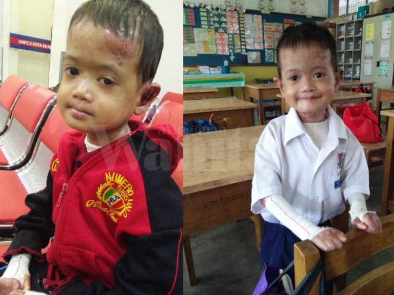 Walau Jari Kaki Dan Tangan Melekat, Alif Tetap Semangat Untuk Ke Sekolah