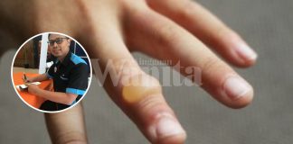 anggota badan melecur