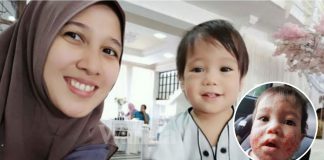 Lima Bulan Jaga Makan & Emosi, Anak Derita Ekzema Pulih Sepenuhnya