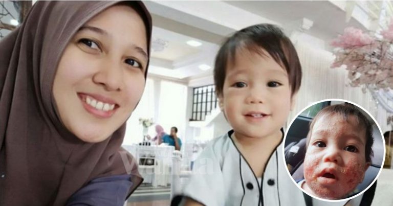 Lima Bulan Jaga Makan & Emosi, Anak Derita Ekzema Pulih Sepenuhnya