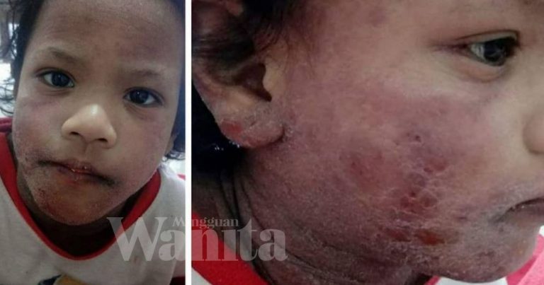 “Sedih Hati Saya Bila Lihat Anak Menggaru-Garu, Kulit Pedih Hingga Berdarah & Keluar Air Bisa” Mimi