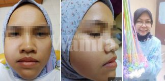 Pakai Braces Lebih Tiga Tahun, Sudahnya Bengkak Muka, Gigi Rosak Teruk