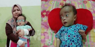 Dalila Derita Holoprosencephaly.Hanya Mampu Terbaring, Mata Pula Tak Nampak
