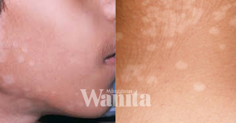 Petua Hilangkan Panau Pada Anak Tanpa Perlu Keluarkan Duit