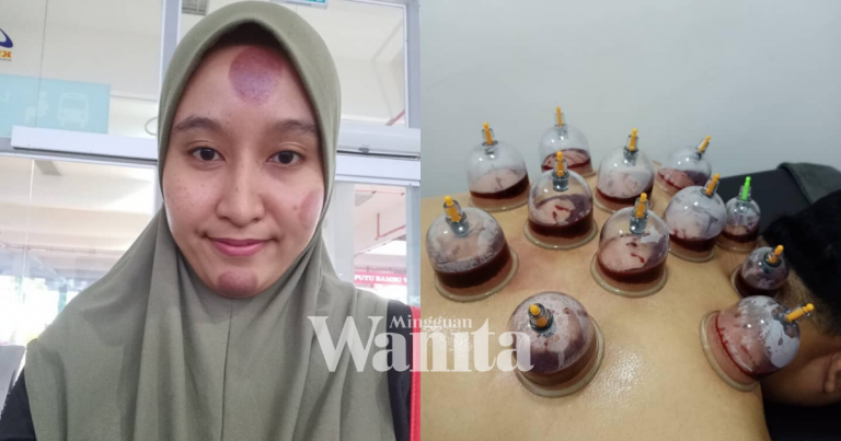 Pesakit Diabetes, Jangan Sembarangan Nak Lakukan Bekam