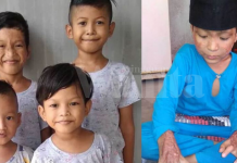 Kasihnya Abang Sanggup Bergadai Nyawa, Melecur Teruk Demi Lindungi Adik