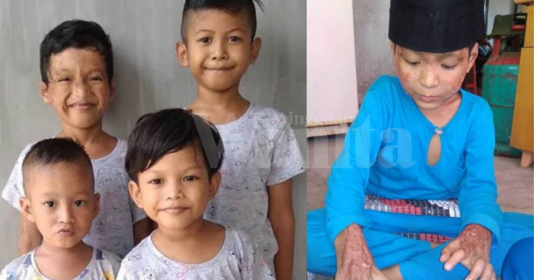 Kasihnya Abang Sanggup Bergadai Nyawa, Melecur Teruk Demi Lindungi Adik