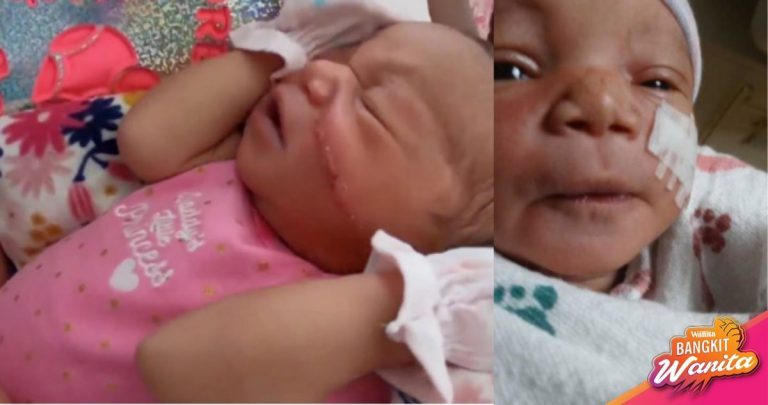 Pipi Tertoreh Ketika Pembedahan, Bayi Baru Lahir Terpaksa Terima 13 Jahitan