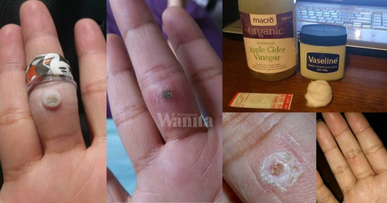 Cara Mudah Hilangkan KETUAT, Buat Sendiri Di Rumah Guna 4 Bahan!