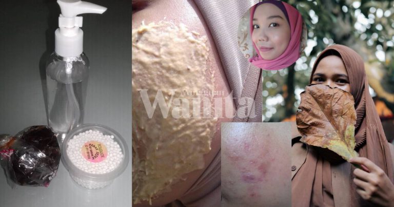 Petua Hilangkan Parut Jerawat Dalam Masa SEMINGGU, Guna Bahan Homemade, Amalkan Setiap Malam