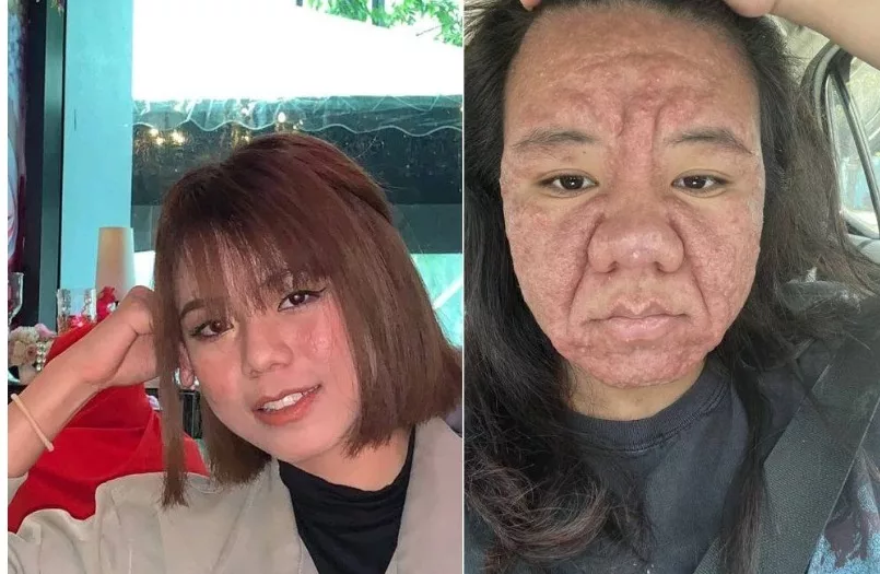 Bukan Penyakit Ain, Wajah Wanita Berkedut Ketika Hamil Kembali Pulih Selepas Bersalin