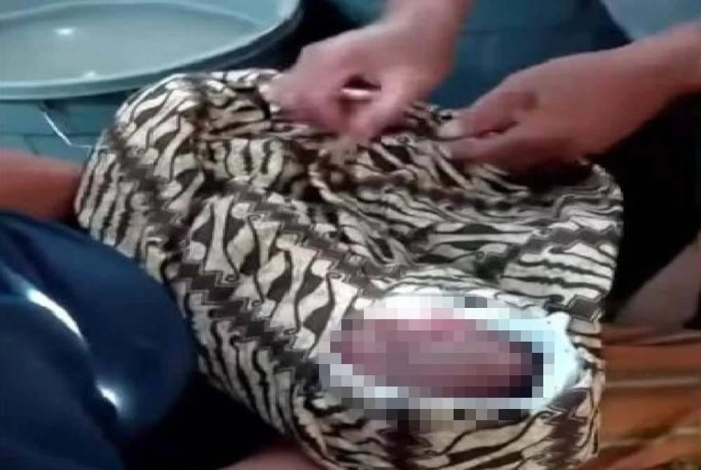Kepala Bayi Terputus, Badan Tertinggal Dalam Perut Ibu Waktu Dilahirkan