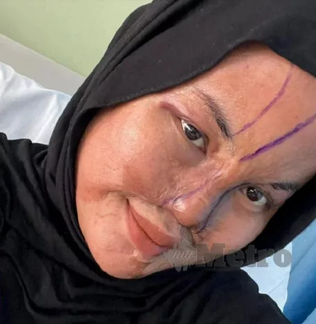 Gadis Mangsa Disimbah Cuka Getah Jalani Pembedahan Hidung, Tak Pernah Berdendam Perbuatan Bapa 7 Gadis Mangsa Disimbah Cuka Getah Jalani Pembedahan Hidung, Tak Pernah Berdendam Perbuatan Bapa