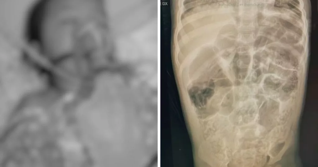 Anak Kecil 4 Tahun Meninggal Akibat Perut Penuh Cacing Gelang, Tragedi Timpa Adik Raya Menyayat Hati