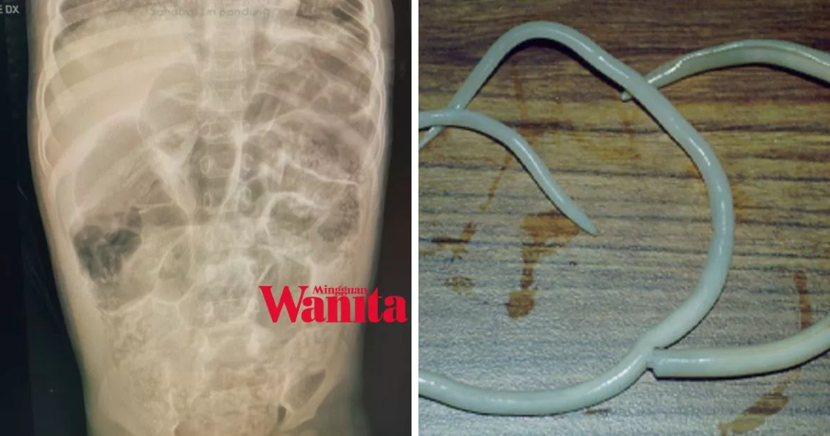 Anak Kecil 4 Tahun Meninggal Akibat Perut Penuh Cacing Gelang, Tragedi Timpa Adik Raya Menyayat Hati