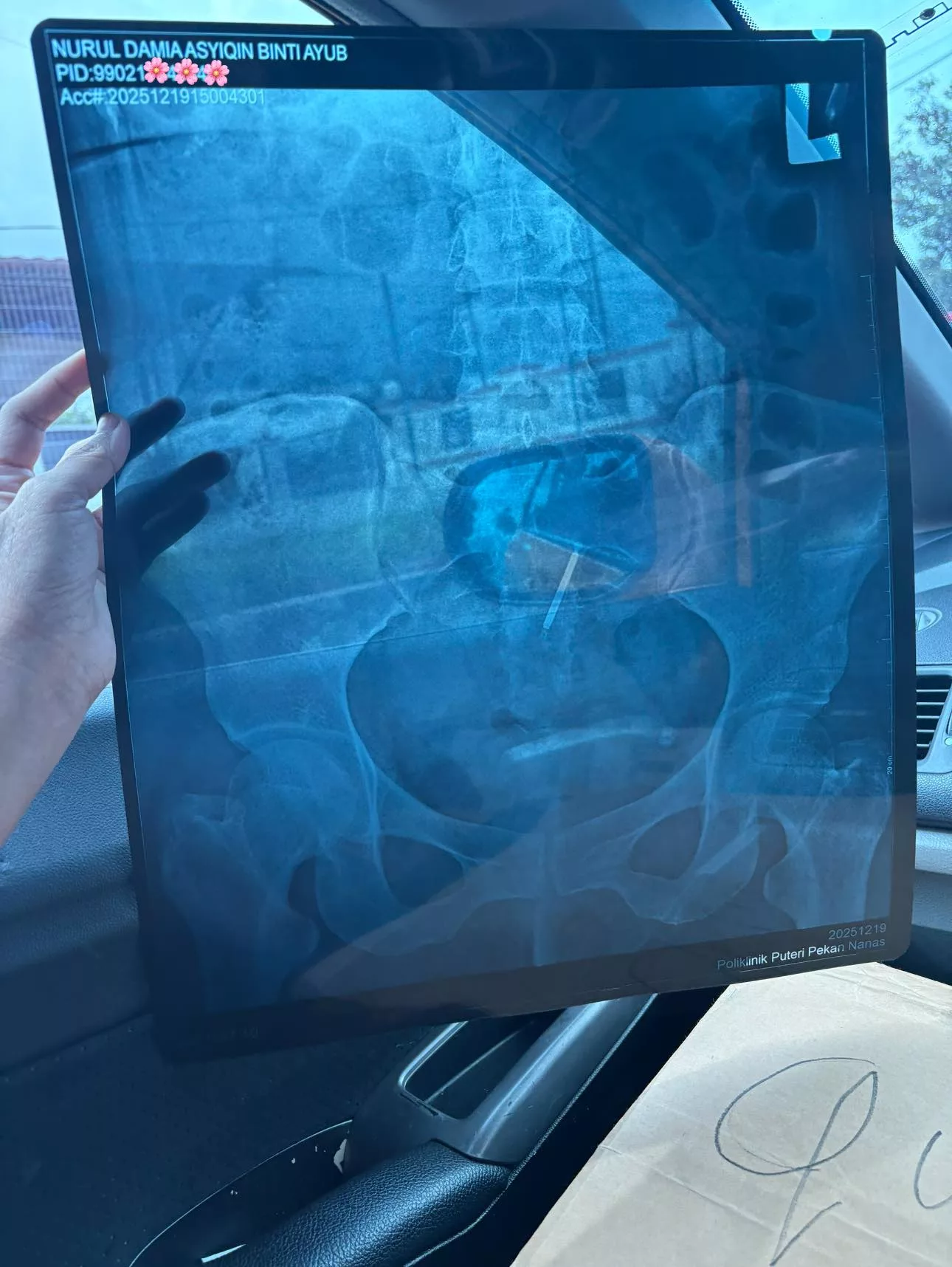 Doktor Salah Pasang IUCD Hingga Tembus Dinding Rahim, Ibu Dua Anak Derita Seumur Hidup