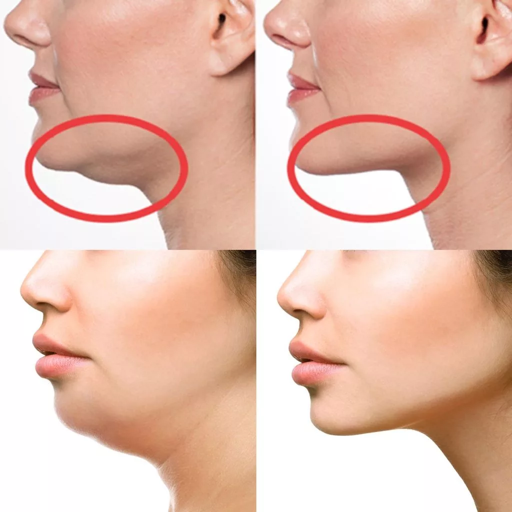 Senaman Hilangkan Dagu Berlapis, Sambil Tengok TV Pun Boleh Buat