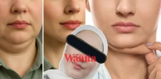 hilangkan dagu berlapis