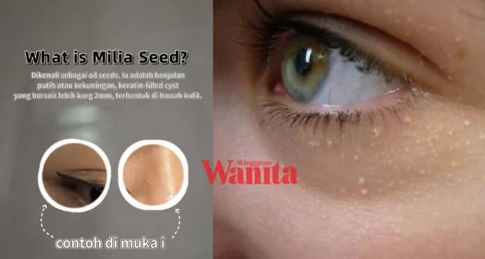Milia Seed