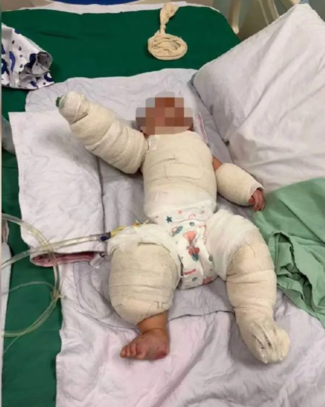 Bayi 5 Bulan Lecur Teruk Insiden Periuk Nasi Terbalik, Ibu Menangis Tengok Keadaan Anak 3 Bayi 5 Bulan Lecur Teruk Insiden Periuk Nasi Terbalik, Ibu Menangis Tengok Keadaan Anak