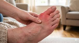 Nasihat Doktor Sempena Raya Korban Buat Pesakit Gout, Jangan Sampai Terlepas Pandang!