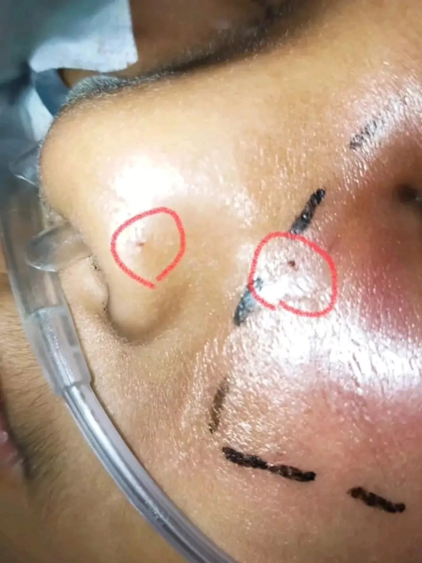 Dipatuk Ular Tedung Cobra Ketika Tidur, Ridzwan 10 Tahun Terlantar Lebih Sebulan Di Hospital & Kini Berjuang Untuk Sembuh 8 Dipatuk Ular Tedung Cobra Ketika Tidur, Ridzwan 10 Tahun Terlantar Lebih Sebulan Di Hospital & Kini Berjuang Untuk Sembuh