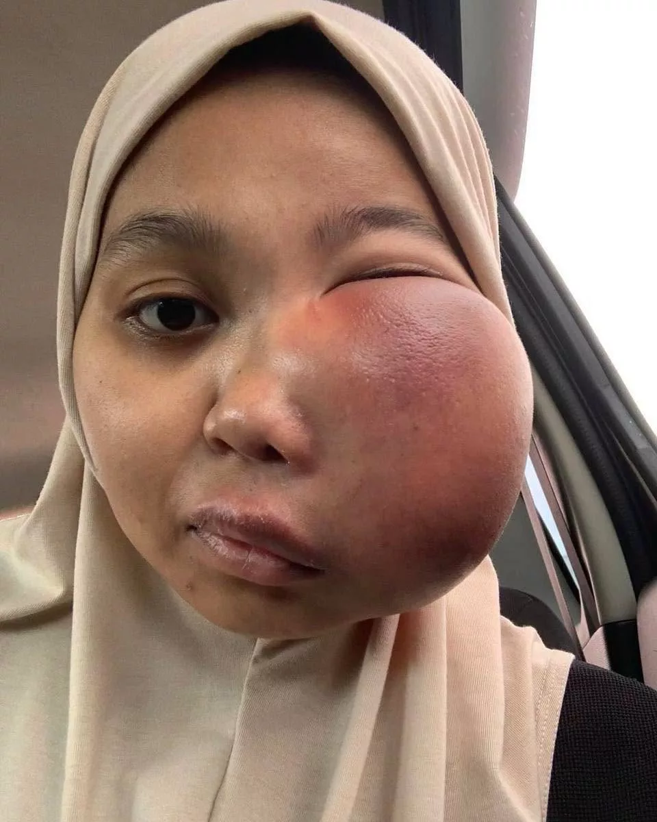 Hidap Kanser Tulang Tahap 4, Suami Setia Jaga Isteri Ketika Sakit & Kini Semakin Sembuh 11 Hidap Kanser Tulang Tahap 4, Suami Setia Jaga Isteri Ketika Sakit & Kini Semakin Sembuh