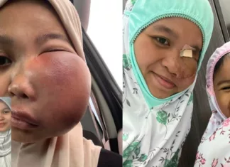 kanser tulang tahap 4