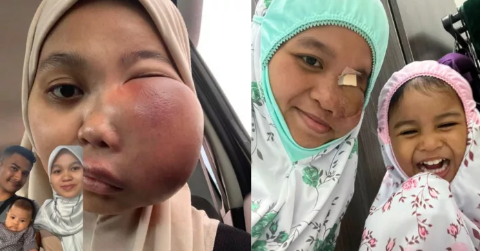 kanser tulang tahap 4 kanser tulang tahap 4