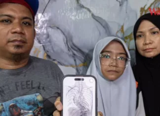 Hidap Masalah Tulang Belakang Bengkok, Remaja Perempuan Perlukan RM10 000 Untuk Pembedahan tulang belakang bengkok