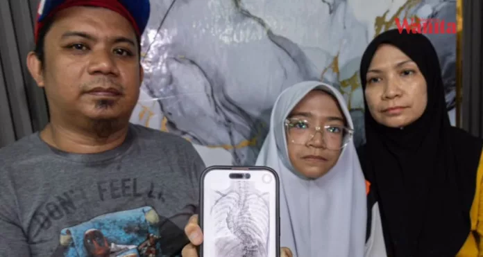 tulang belakang bengkok