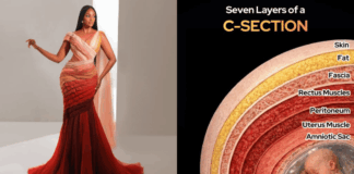bersalin c-section
