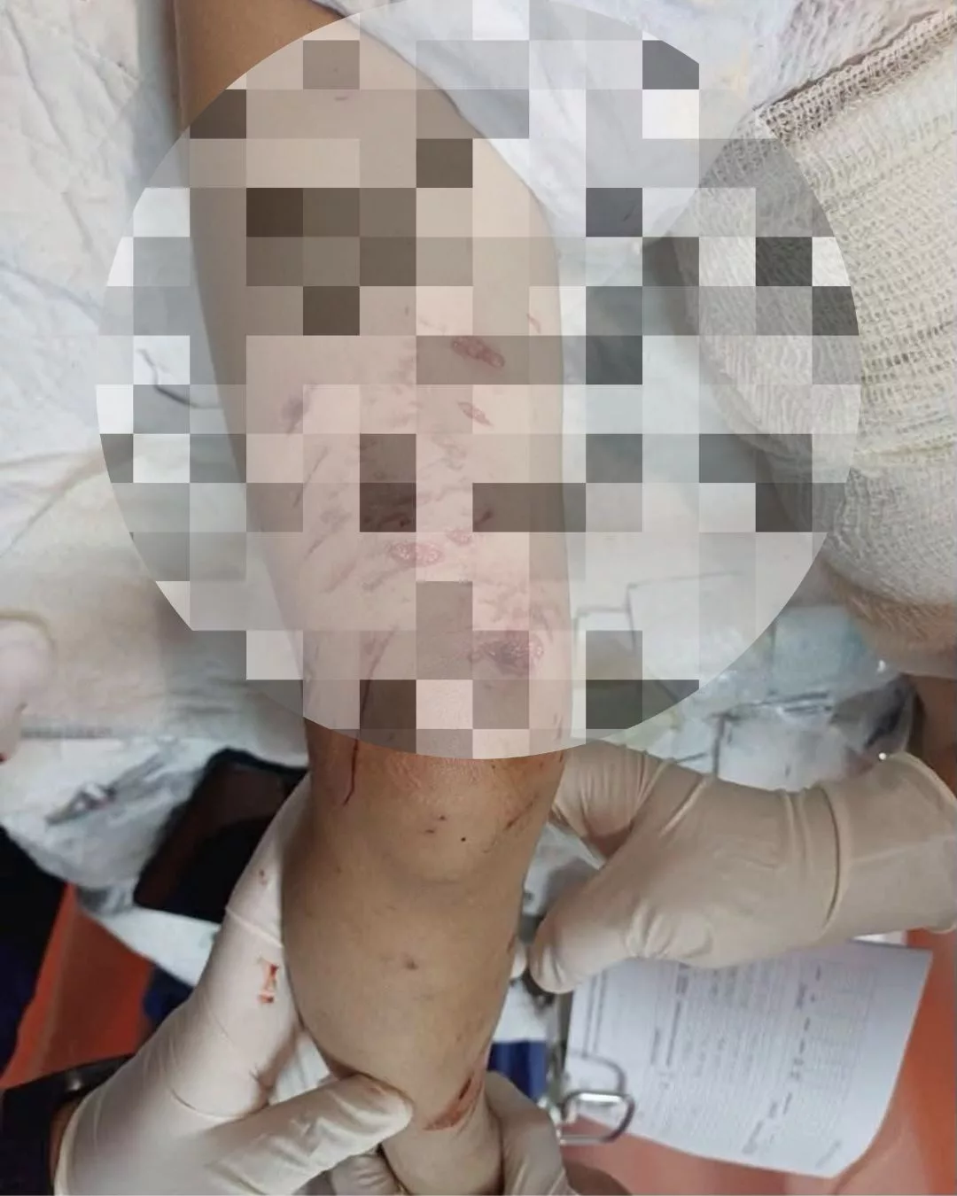budak 2 tahun parah digigit anjing