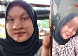 Sakit Tapi Tiada Pilihan, Mangsa Simbahan Cuka Getah Cuba Bertahan Pulihkan Wajah Simbahan Cuka Getah