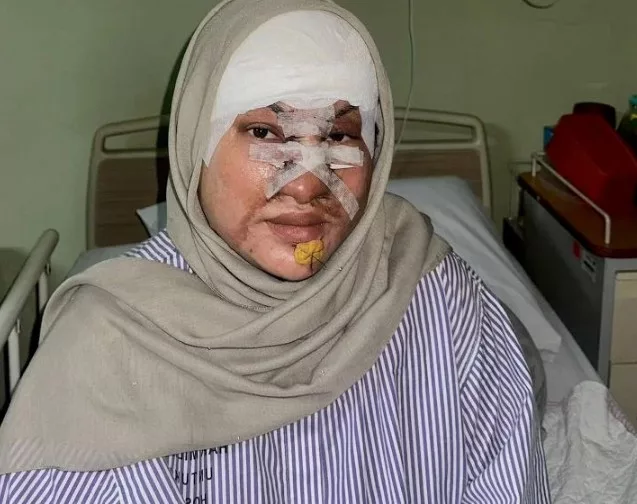 Sakit Tapi Tiada Pilihan, Mangsa Simbahan Cuka Getah Cuba Bertahan Pulihkan Wajah 2 Sakit Tapi Tiada Pilihan, Mangsa Simbahan Cuka Getah Cuba Bertahan Pulihkan Wajah
