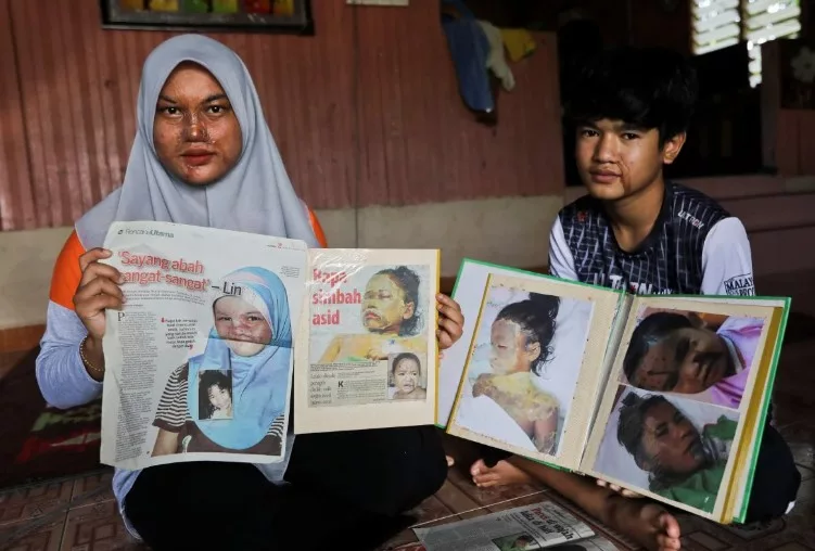 Sakit Tapi Tiada Pilihan, Mangsa Simbahan Cuka Getah Cuba Bertahan Pulihkan Wajah 3 Sakit Tapi Tiada Pilihan, Mangsa Simbahan Cuka Getah Cuba Bertahan Pulihkan Wajah
